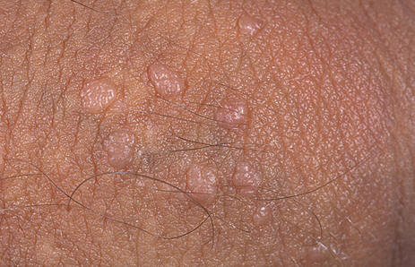 طول عمر ویروس hpv