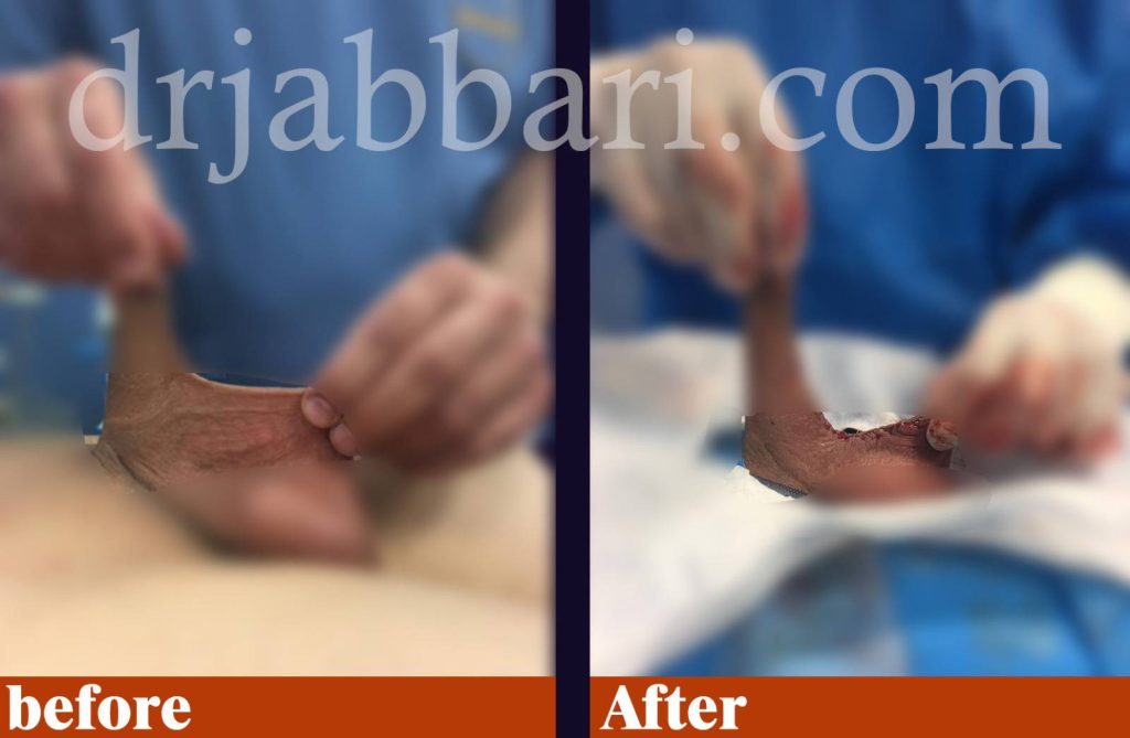 آلت تناسلی پرده دار