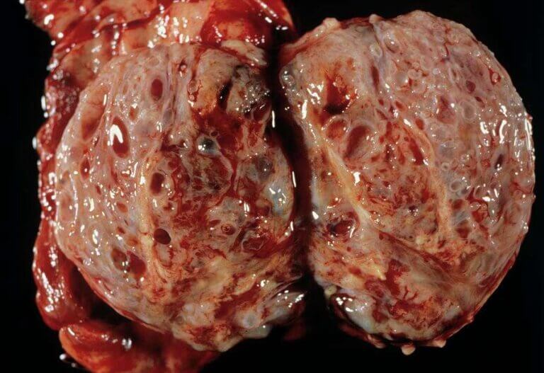 عکس سرطان بیضه: