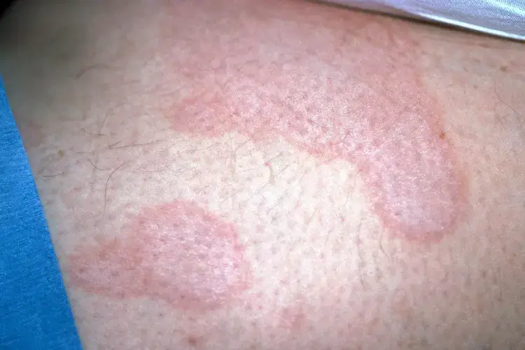 علل بیماری لیکن اسکلروزیس