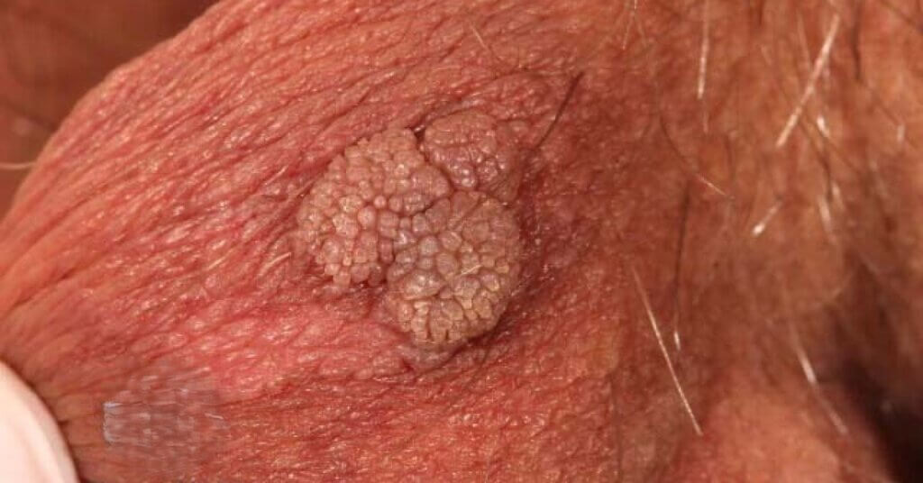 زگیل بیضه