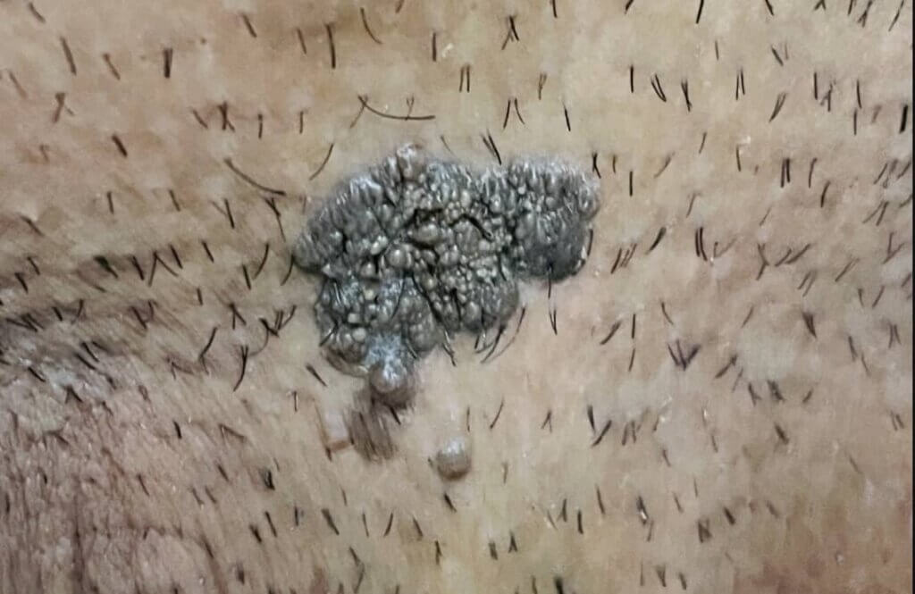زگیل تناسلی سرطانی