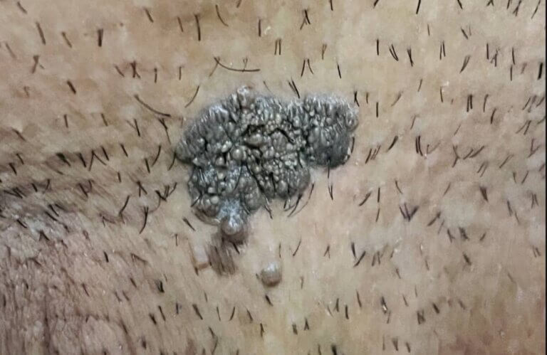 زگیل تناسلی سرطانی