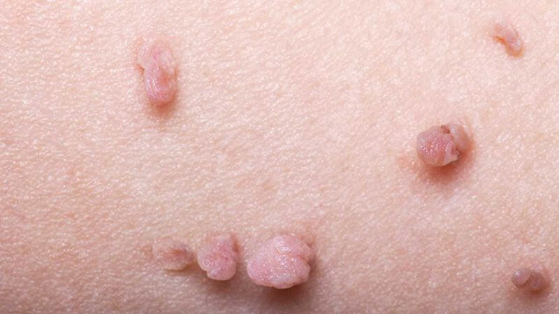 پرسش و پاسخ در مورد زگیل تناسلی