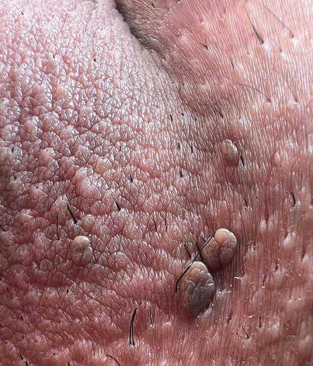 خطرات زگیل تناسلی