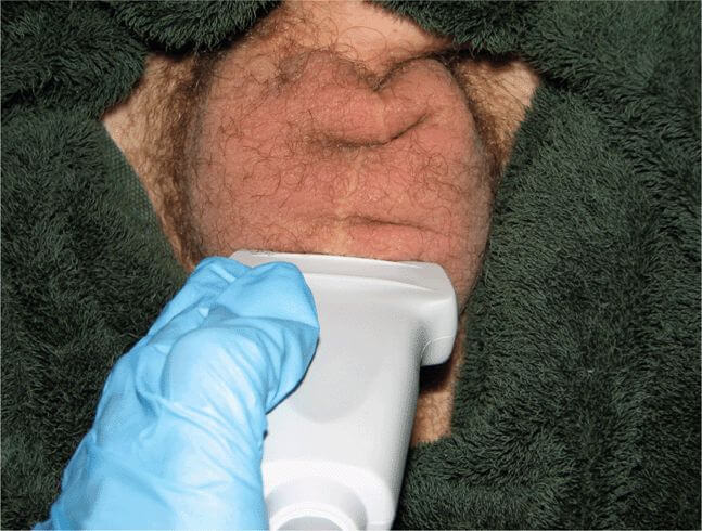 عکس سونوگرافی از بیضه 2