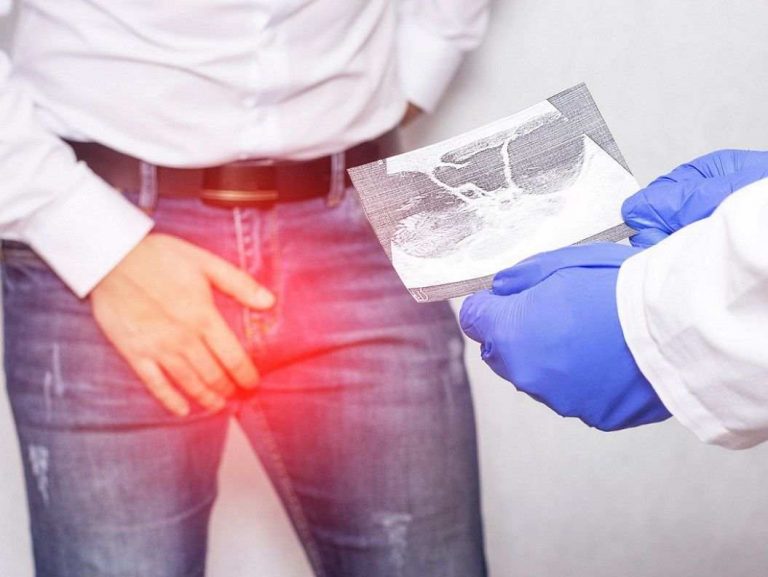 ترمیم واریکوسل