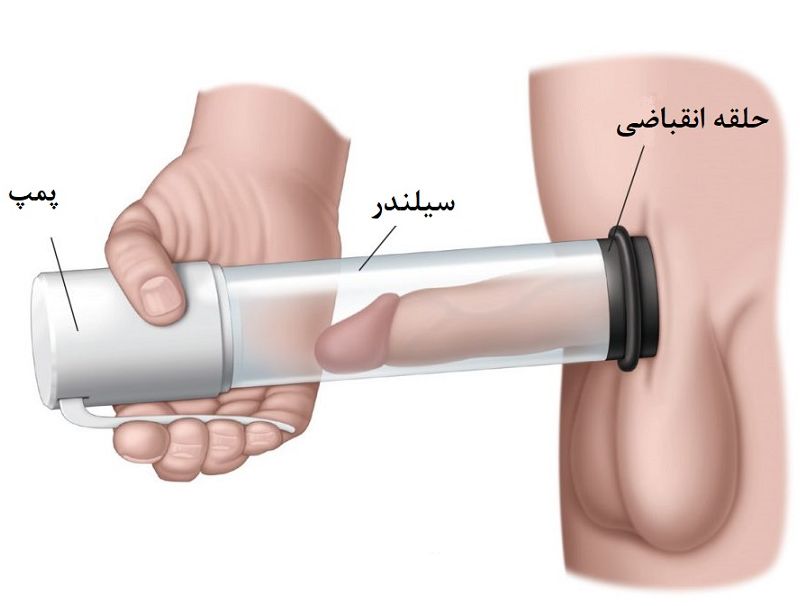 درمان زود انزالی در افراد دیابتی