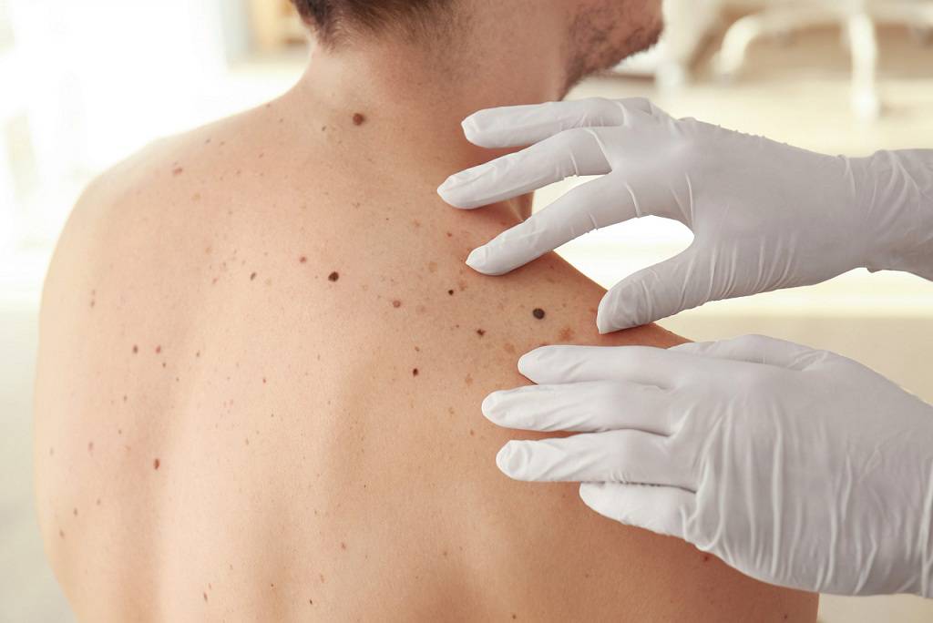 کراتوز سبورئیک چه بیماری است؟