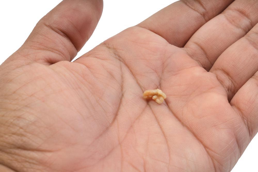 Are kidney stones dangerous?
