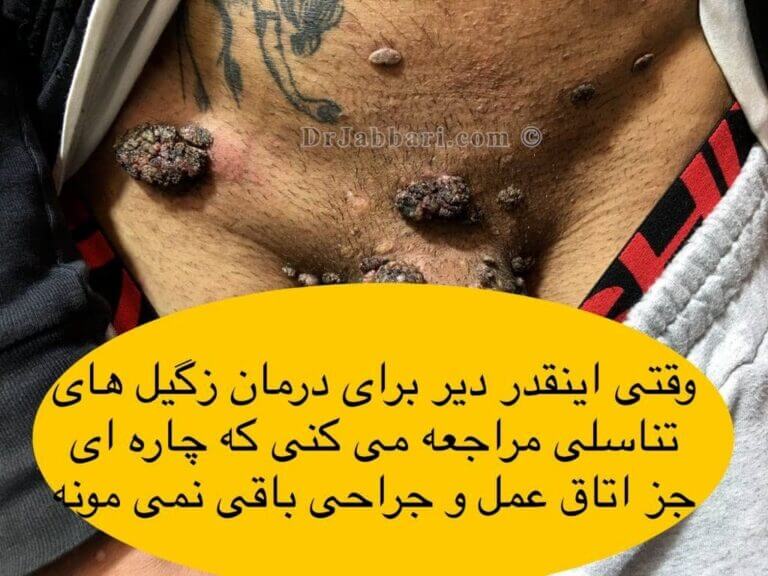 زگیل های تناسلی گل کلمی