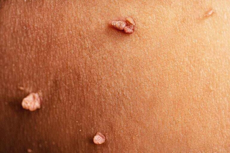 زگیل تناسلی چیست؟