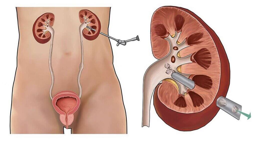 عمل pcnl