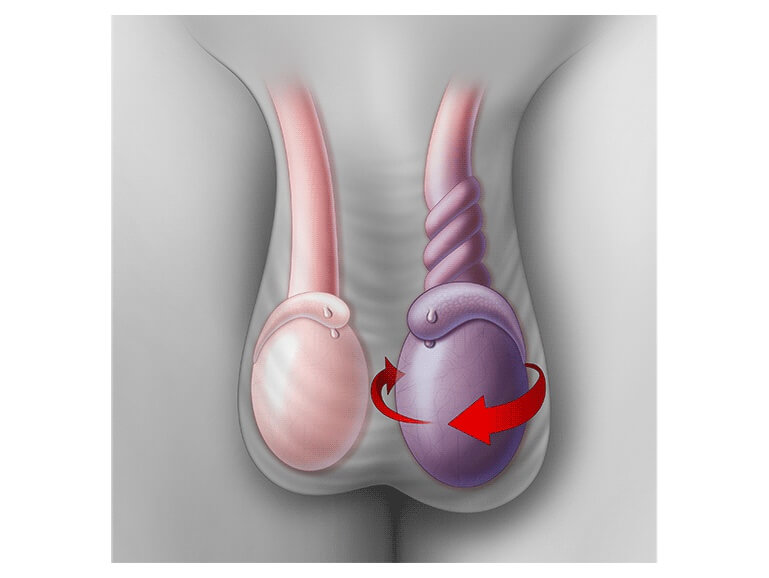 پیچ خوردگی بیضه