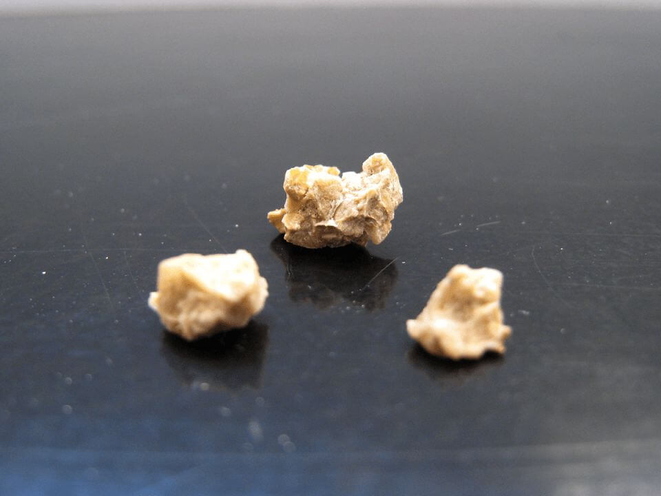 انواع سنگ کلیه