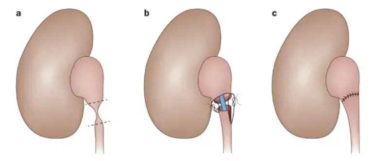 جراحی (پیلoplasti - Pyeloplasty)