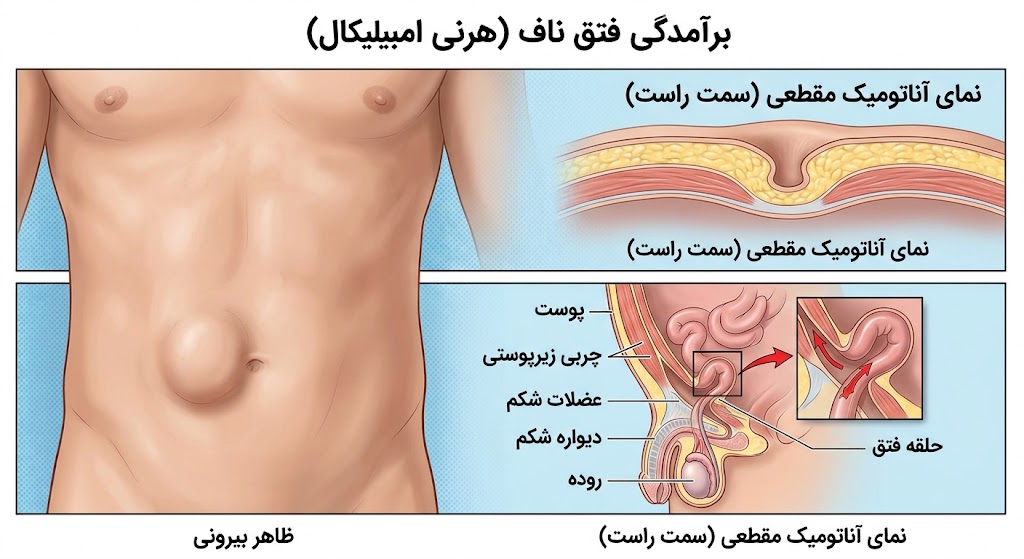 عکس فتق ناف
