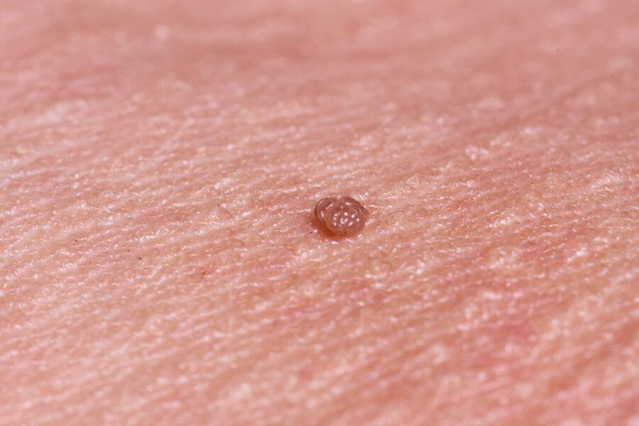 زگیل تناسلی