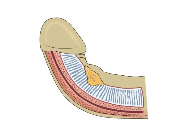 بهترین درمان پیرونی