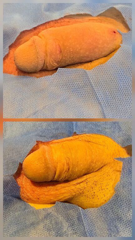 نمونه قبل و بعد تزریق ژل