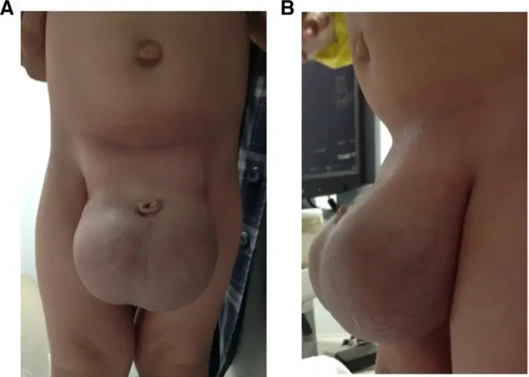 علل رایج بزرگ شدن بیضه