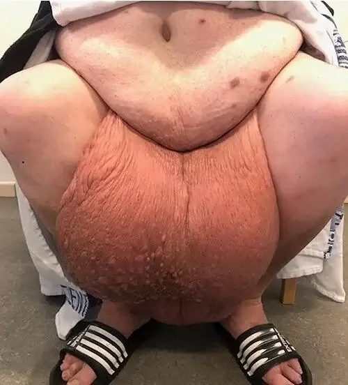 بیضه بزرگ