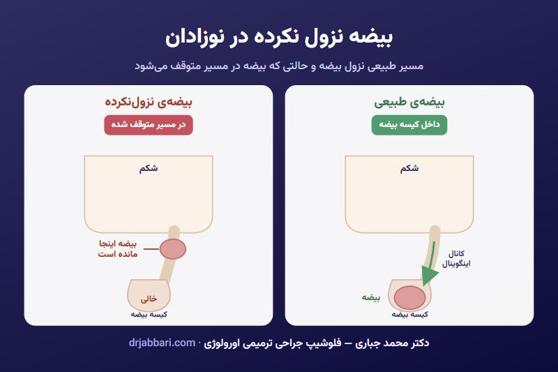 بیضه نزول نکرده در نوزاد: مقایسه بیضه طبیعی داخل کیسه بیضه با بیضه‌ای که در مسیر نزول متوقف شده